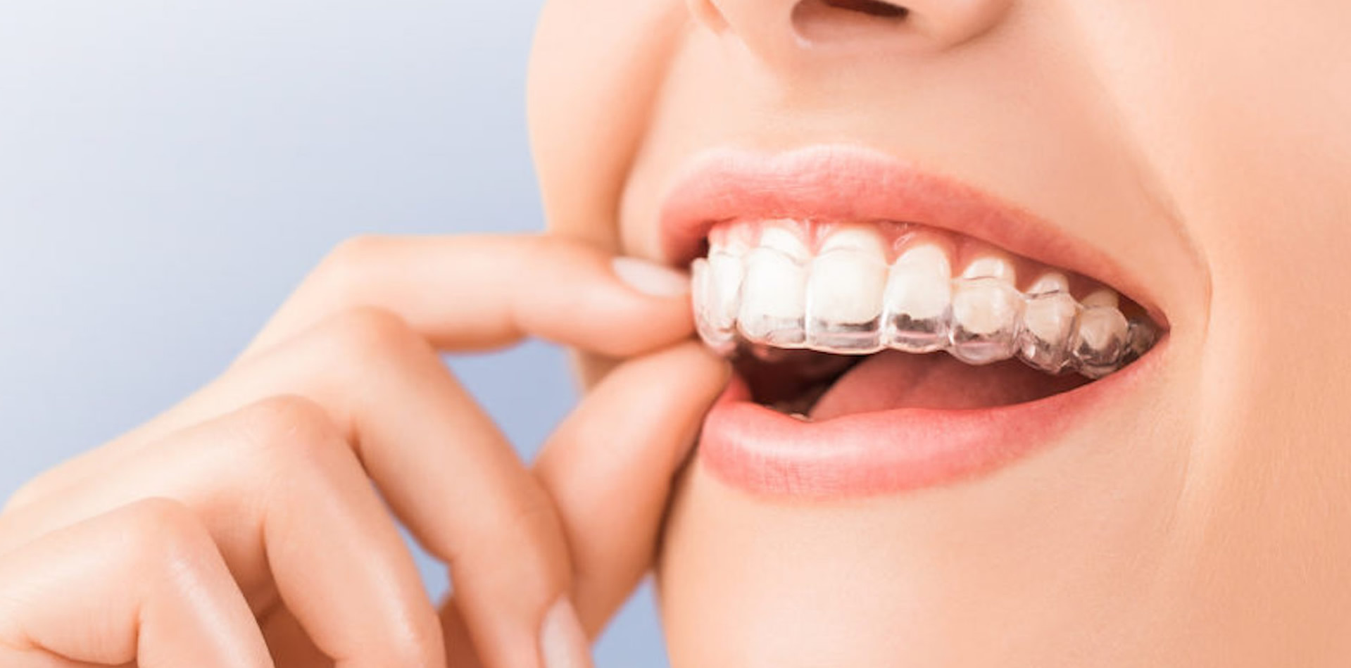 Invisalign Dra Natalia Brainer